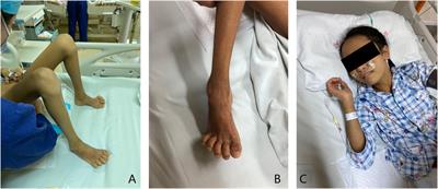 Two novel mutations in VPS33B gene cause a milder ARC syndrome with prolonged survival in a 12-year-old patient: Case report